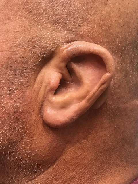 Custom silicone ear prosthesis restoring a natural ear