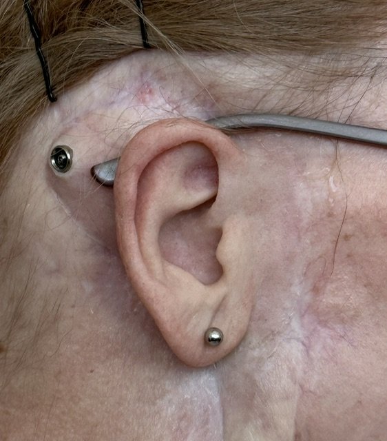Implant-supported custom ear prosthesis restoring a natural ear