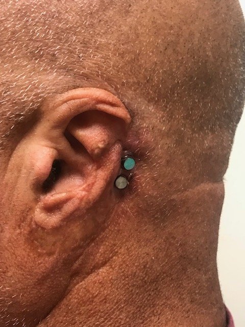 Ear with implant retention abutments before a custom ear prosthesis