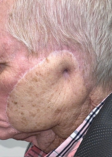 Patient with a missing ear before a custom ear prosthesis