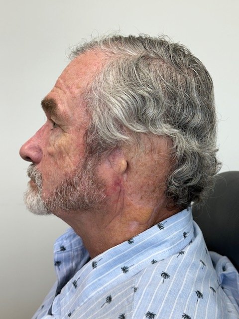 Profile of a patient with a missing ear before a custom ear prosthesis
