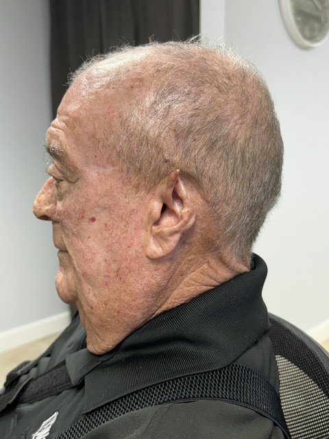 Profile of a patient with a partial ear before a custom ear prosthesis
