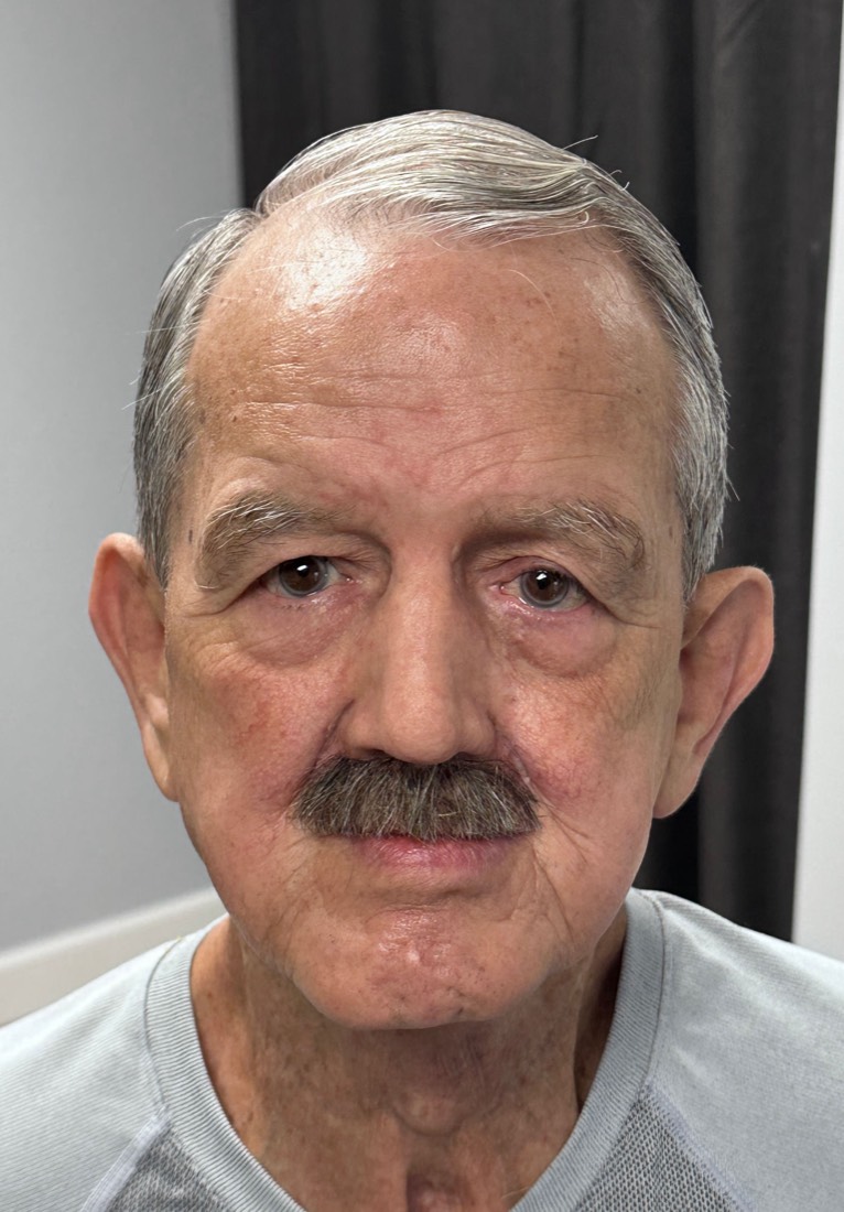 Patient after a custom silicone nasal prosthesis restoring facial symmetry