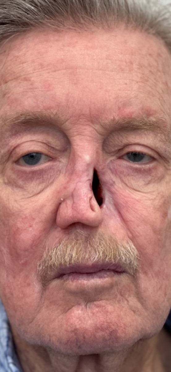 Patient with a nasal defect before a custom nasal prosthesis