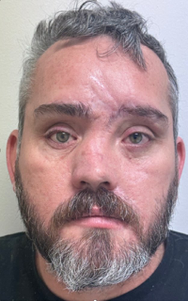 Patient after a custom ocular prosthesis restoring a natural appearance
