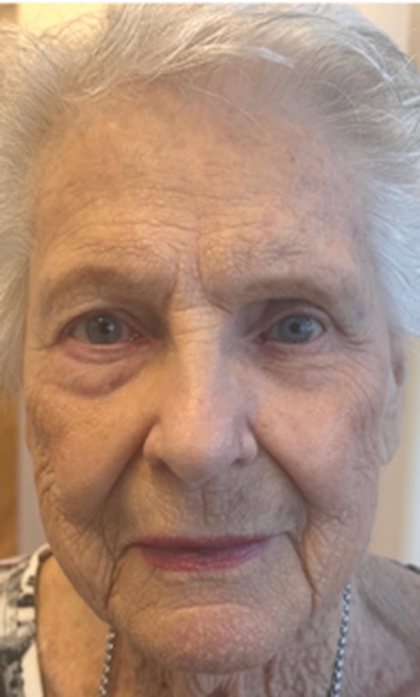 Patient after a custom ocular prosthesis restoring a balanced appearance