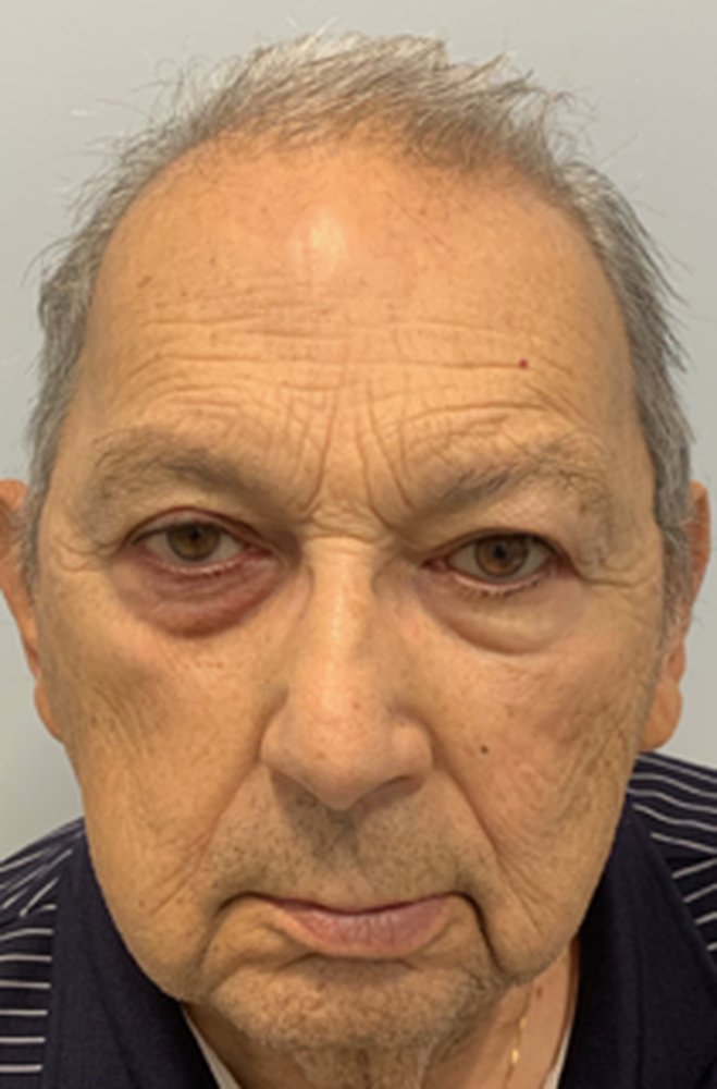 Patient after a custom ocular prosthesis fitted for a lifelike match