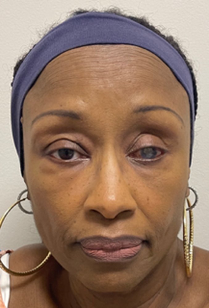 Patient before a custom ocular prosthesis