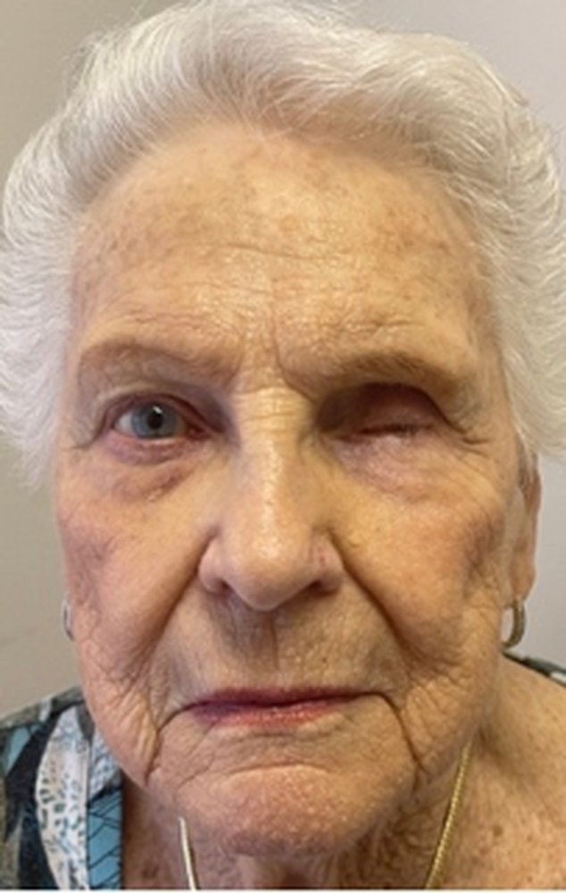 Patient before a custom ocular prosthesis