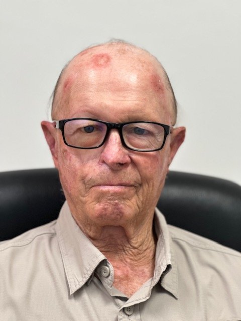 Patient after a custom orbital prosthesis restoring a natural appearance