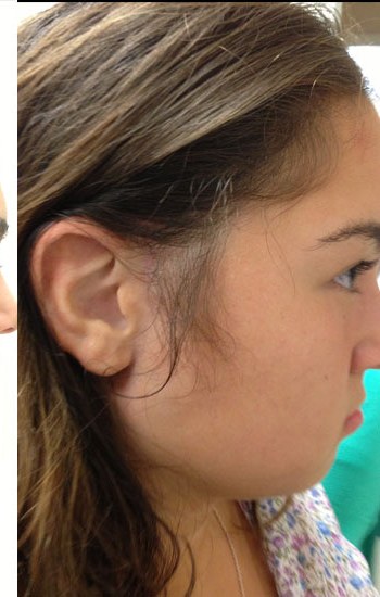 Child after a custom ear prosthesis blended to the child’s skin and hairline