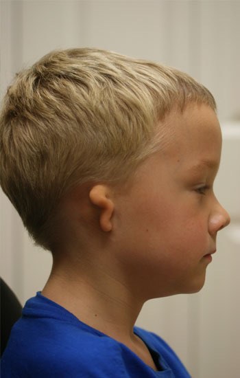 Child before a custom ear prosthesis