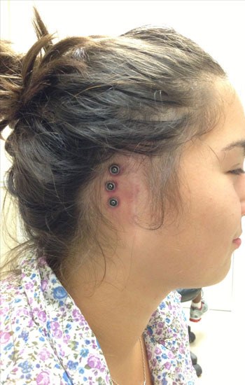 Child before a custom ear prosthesis