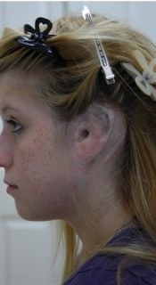 Child before a custom ear prosthesis